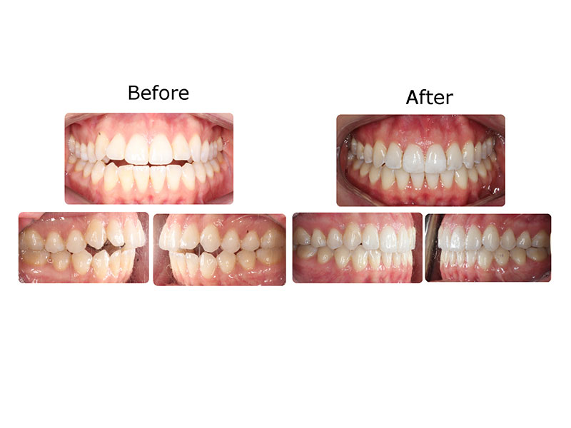 Invisalign First - Ages 7 - 12 Years, Dr. Dona Seely