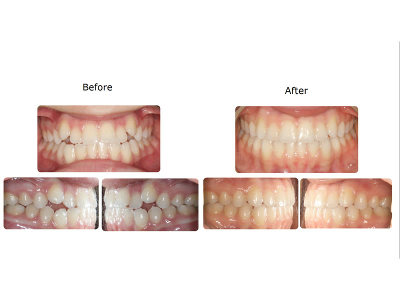 Before and after photographs of a patient treated with Invisalign and OrthoPulse over eight months