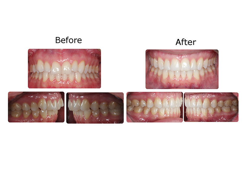 Before and after photographs of a patient treated with Invisalign and MOPs over nine months