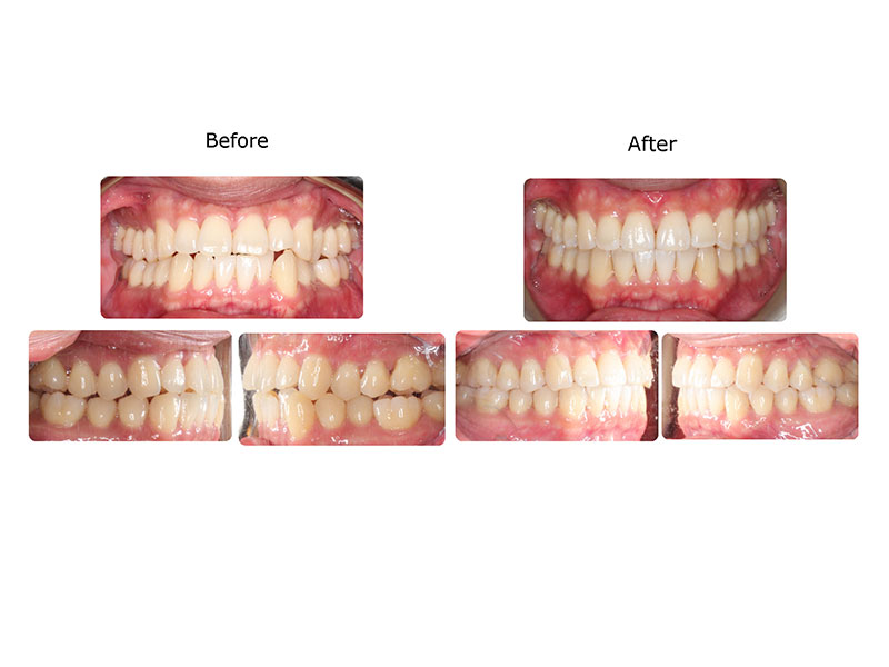 Before and after photographs of a patient treated with Invisalign and MOPs over six and a half months