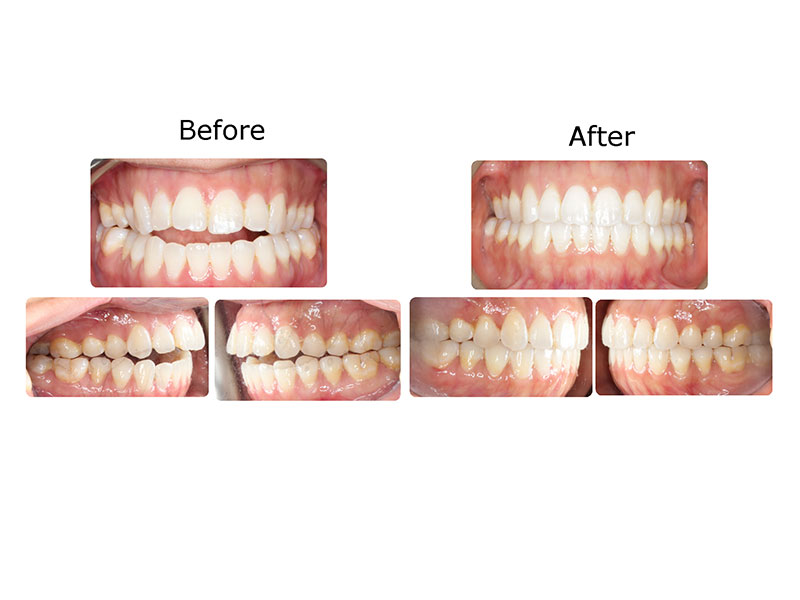 Before and after photographs of a patient treated with Invisalign and VPro over nine months