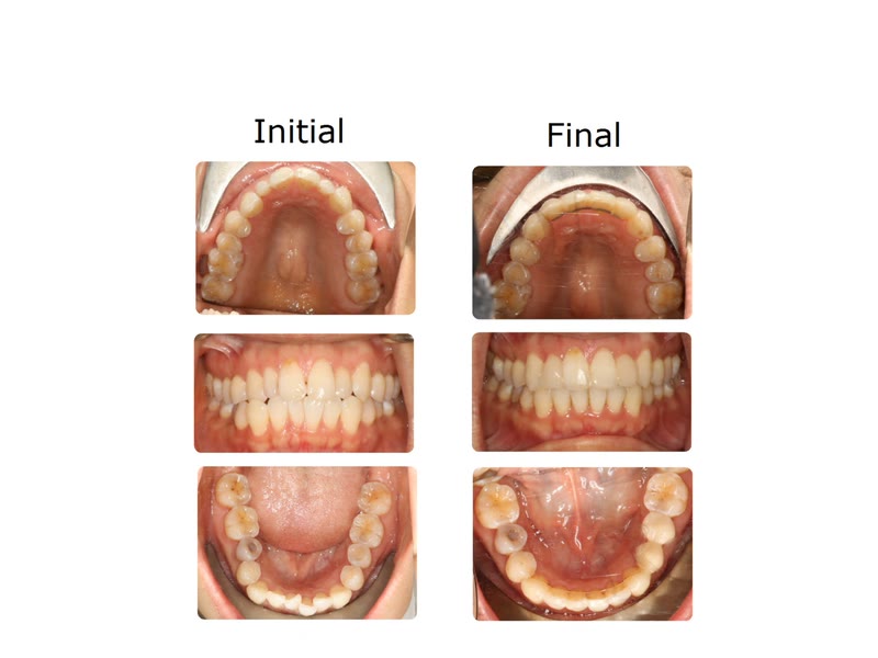 Before and after photographs of a patient treated with Invisalign and OrthoPulse over seven months
