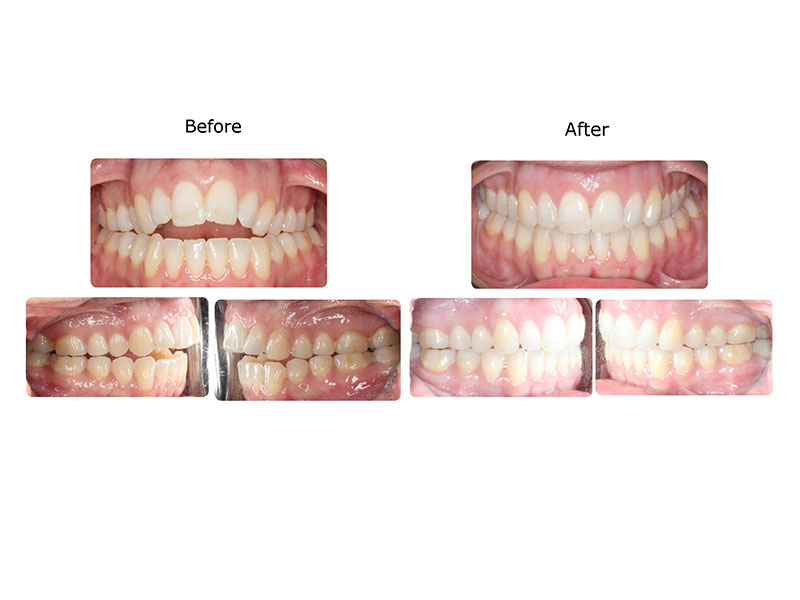 Before and after photographs of a patient treated with Invisalign and VPro over ten months