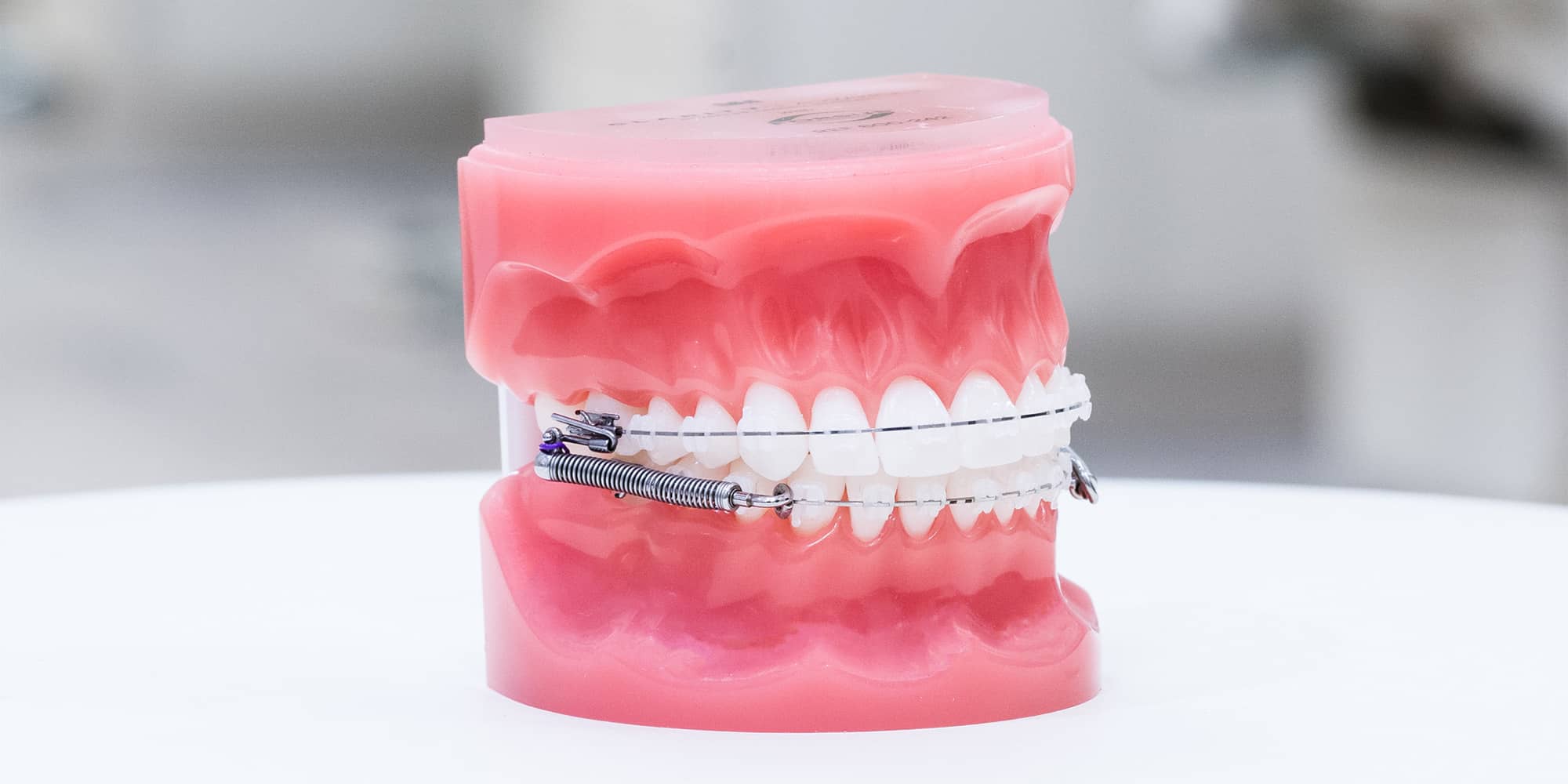 A Forsus appliance fitted alongside braces on a dental model