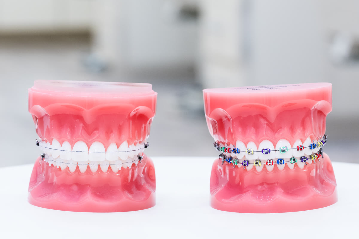 Two dental models side by side, one with clear elastics and one with coloured elastics