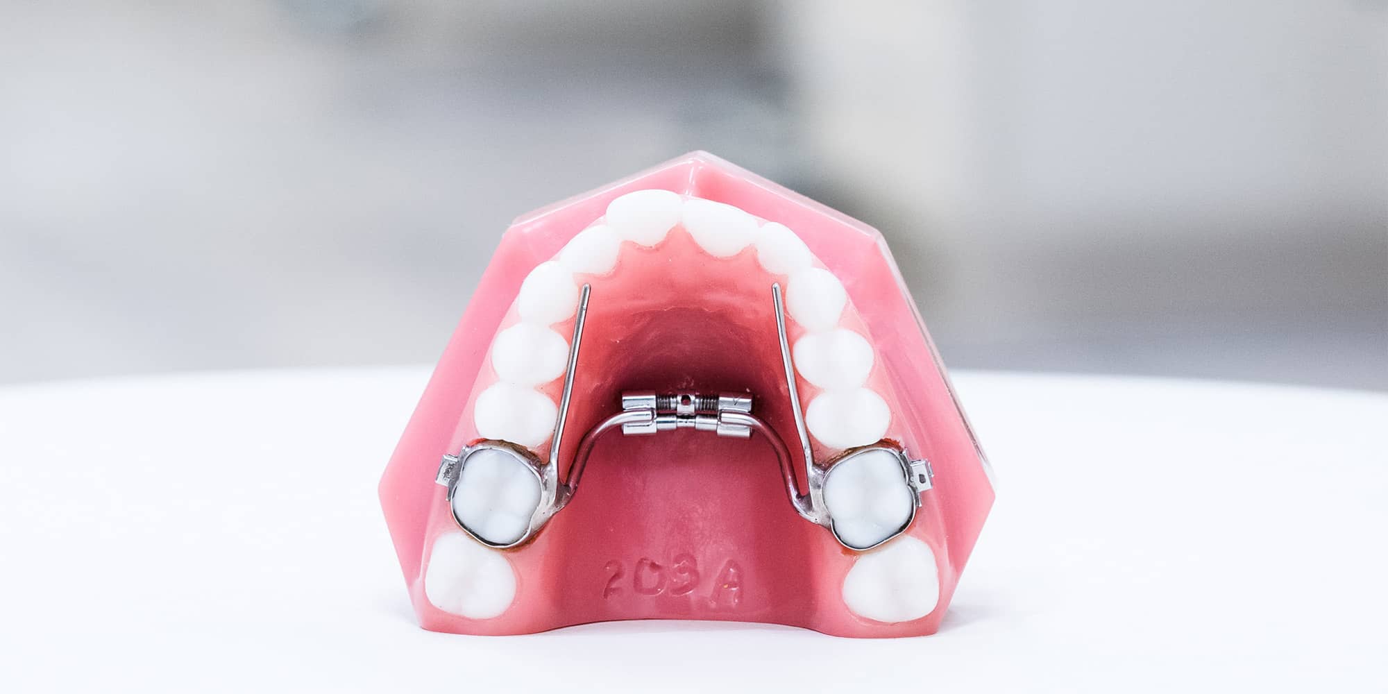 A mini palatal expander appliance on a dental model