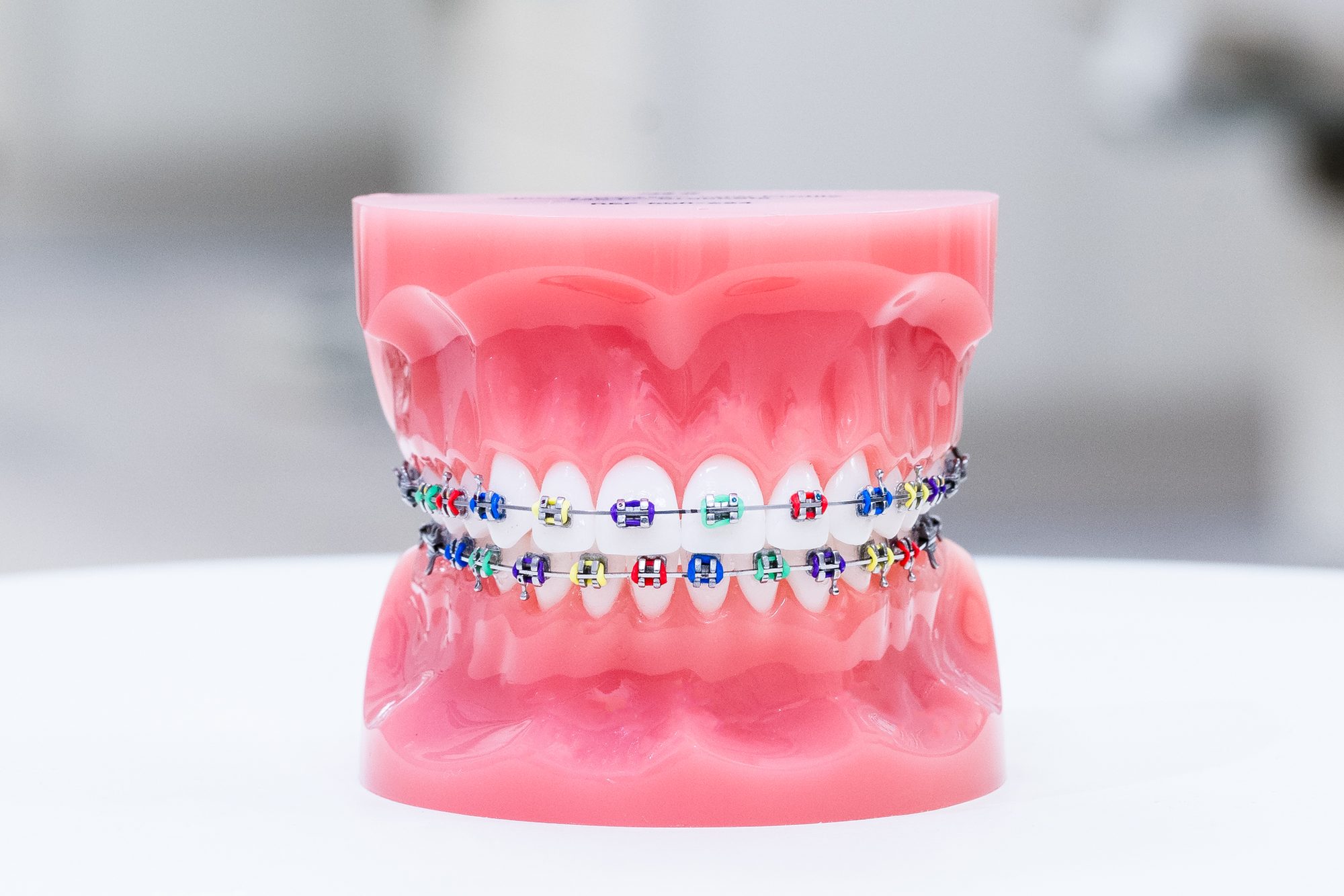 Upper and lower dental model fitted with metal braces and coloured elastics