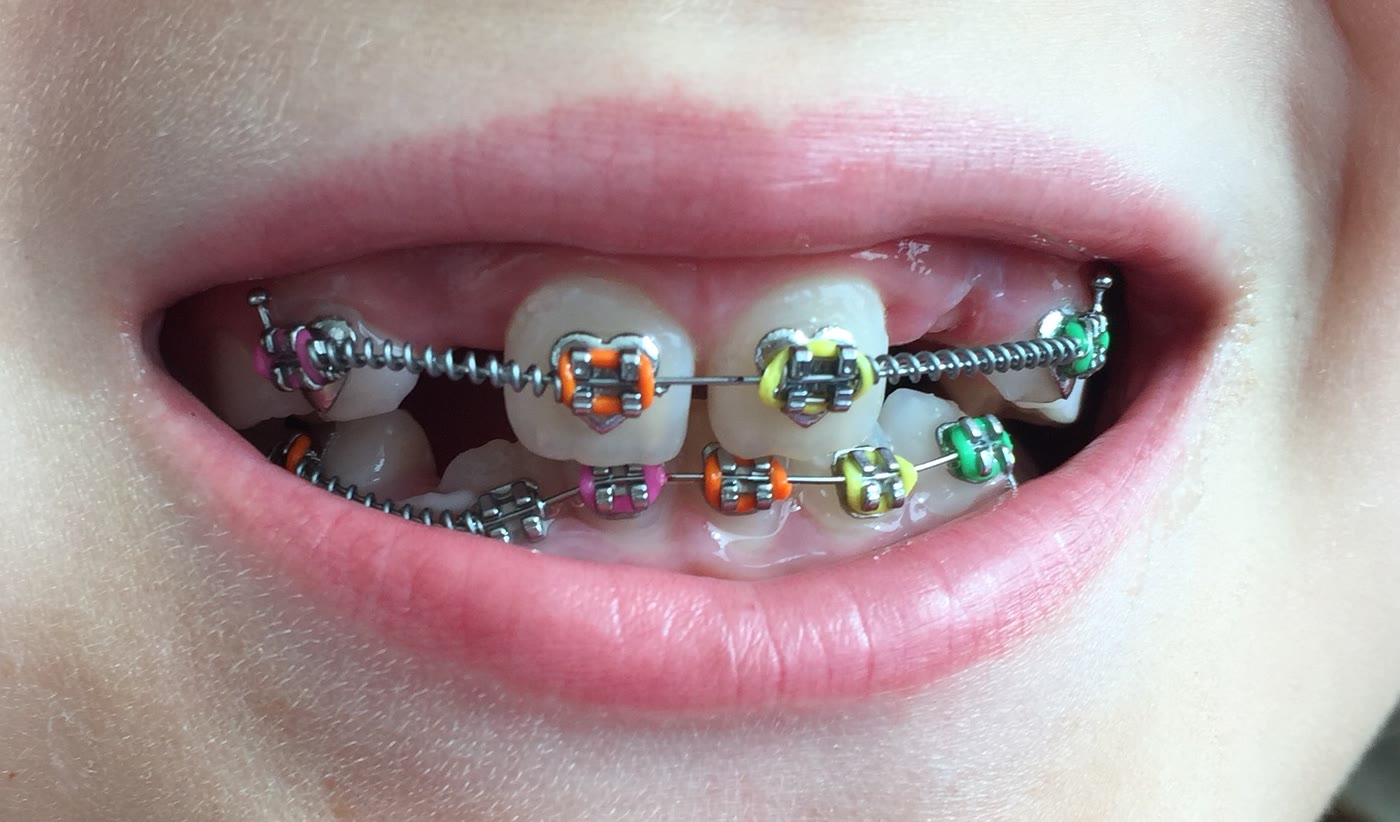 A child’s teeth fitted with braces and coloured elastics during Phase One treatment