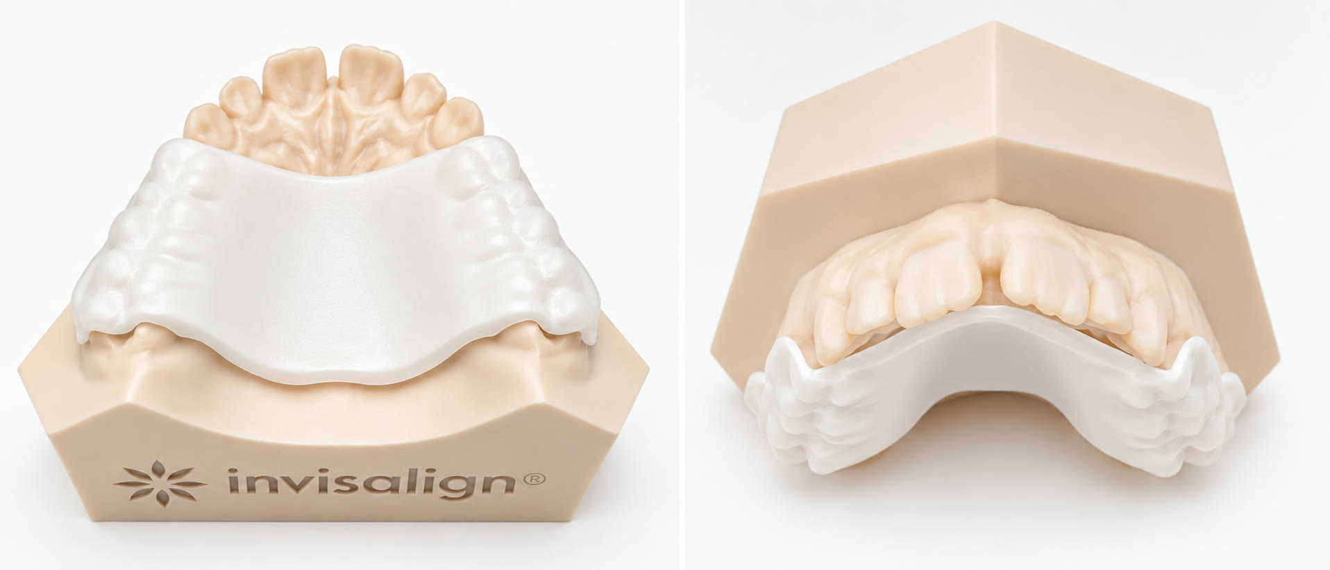 Two views of the Invisalign Palatal Expander seated on a model of the upper jaw