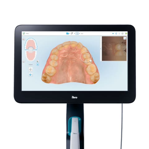 An iTero intraoral scanner showing a 3D scan of the upper teeth