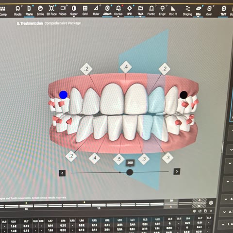 A 3D treatment plan showing the planned tooth movements on screen