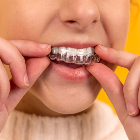 A patient fitting a clear aligner over their teeth