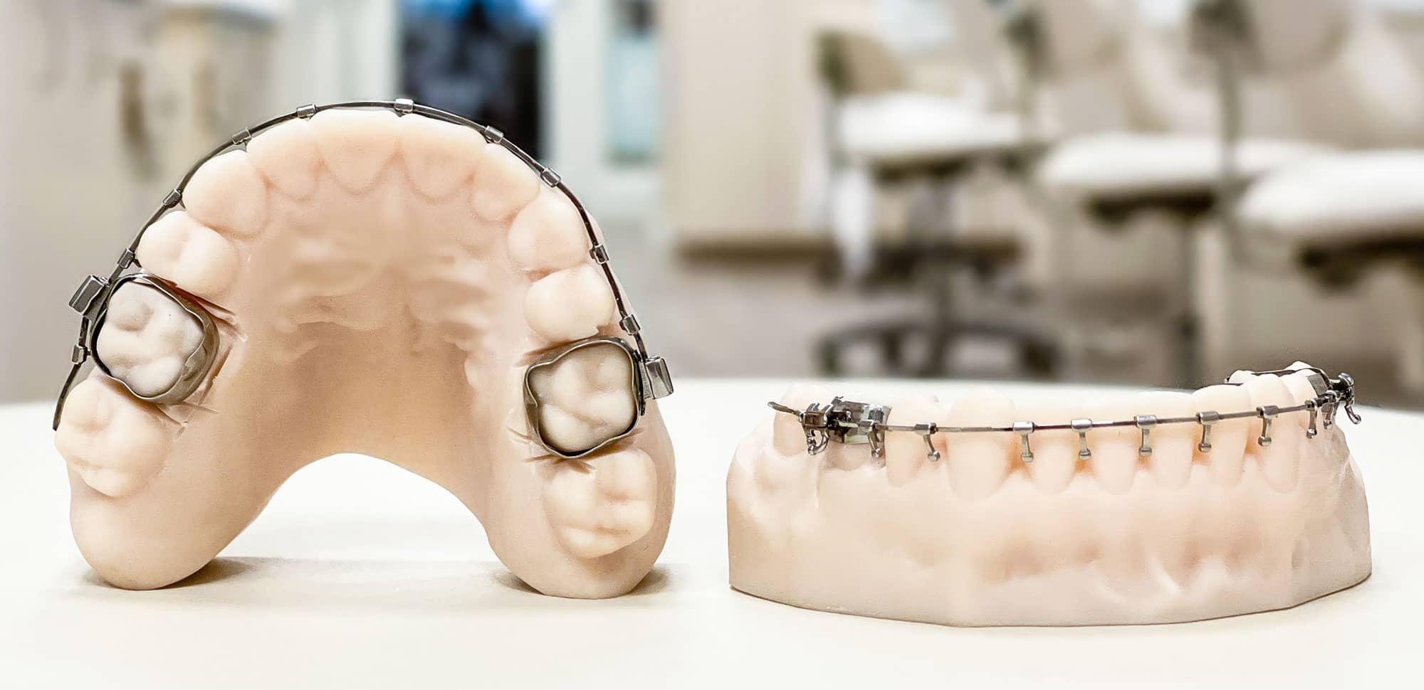Dental models fitted with a lingual arch and lower braces