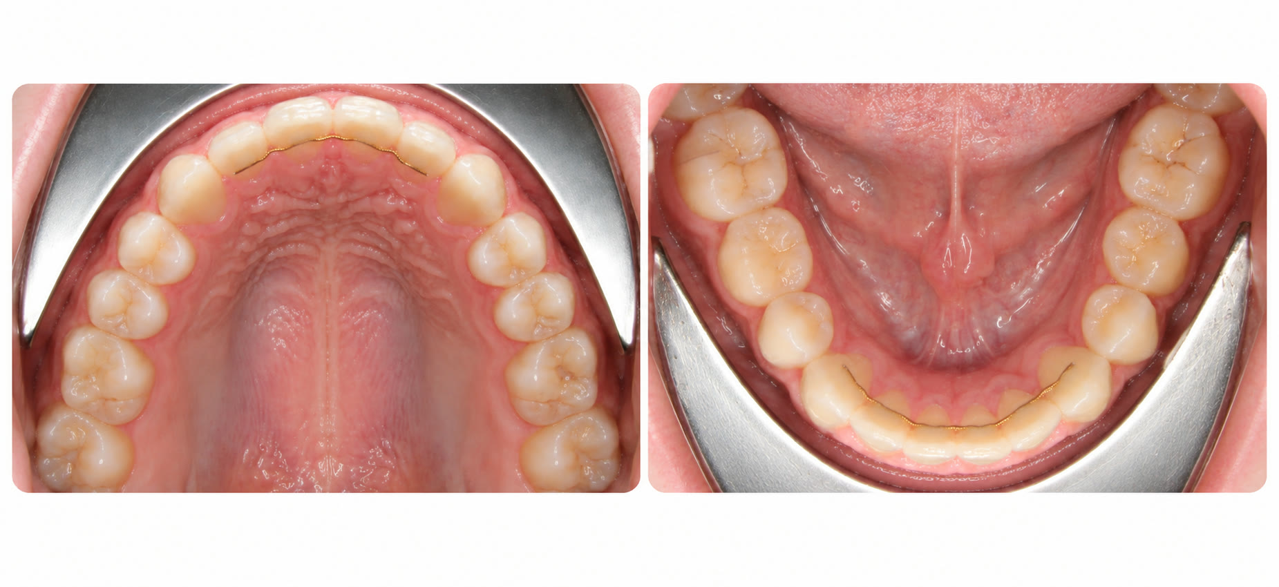 Upper and lower views of slim bonded retainer wires behind the front teeth
